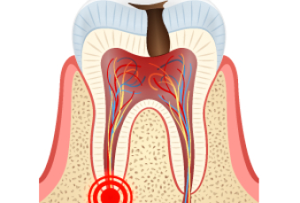염증이 진행된 충치